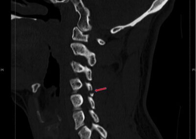 Cervical facet/joint fracture treated with Collar