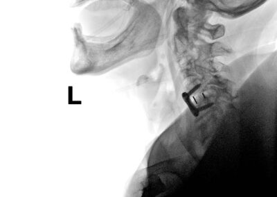 C4-5 stenosis x-ray (post-op)
