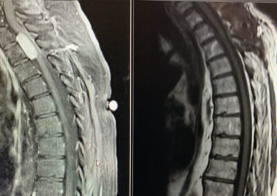 Thoracic Spinal cord tumor MRI pre & post surgery