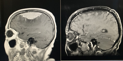 Brain tumor MRI before & after Surgery side view
