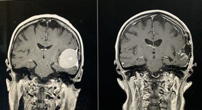 Brain tumor MRI before & after Surgery front view
