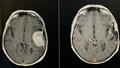 Brain tumor MRI before & after Surgery top view