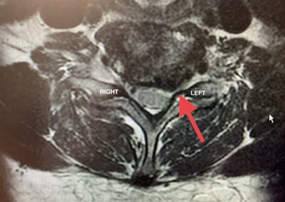 C6-7 MRI left sided stenosis (nerve impingement)