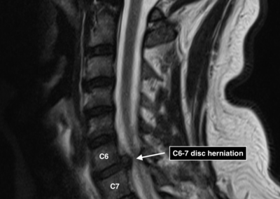 C6-7 disc herniation MRI