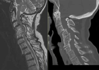 Severe-Spinal-cord-compression-MRI-CT-before-surgery
